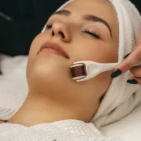 Radiofrequência Microagulhada